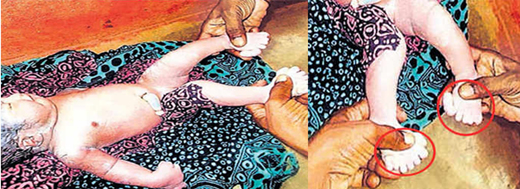 Jharkhand girl born with 40 fingers and teeth, has no tongue